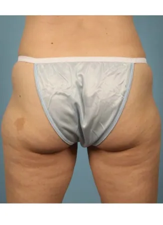 Before This 42 year old Atlanta woman wanted to contour her outer thighs.  Dr. Kavali discussed her options, and she chose to have liposuction done in the office under local anesthesia (awake, but numb).  She is shown before and 6 months after her procedure.