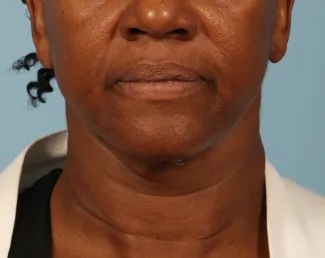 After This Atlanta woman had a facelift using a SMAS lift technique that lifts and tighten the lower face, jawline, and neck.  She is shown about 6 months after her outpatient surgery was done.