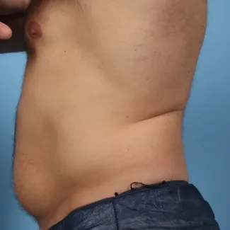 Before This Atlanta male chose CoolSculpting to contour his abdomen and waist. He is shown before and about 2 months after his treatment. He completed 3 treatment cycles