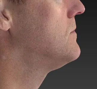 After Note the improved contour of the jawline and the decreased fullness under the chin after an Ulthera treatment.