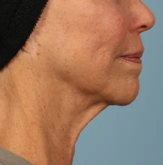 Before Ulthera results: note the slimmer neck and tighter jawline.