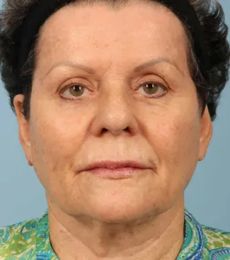 After This 71 year-old female didn’t want any surgery, but wanted a fresher look.  She had 3 syringes of Voluma, as well as Botox for her “11s”, forehead, and crows’ feet.  She is shown about 3 months after her treatment was done.