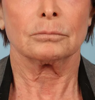 Before An incredible result from Ulthera and Nectifirm.  Ulthera uses the power of ultrasound to lift, tighten, and stimulate collagen.  Nectifirm uses powerful ingredients to produce smoother, tighter skin--it's a topical cream!