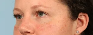 After After 1 syringe of Juvederm Vollure and 1 syringe of Juvederm Ultra to correct undereye hollows