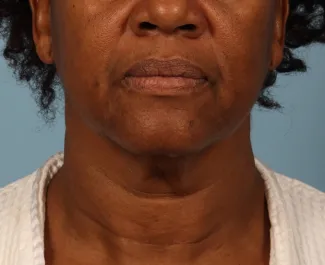 Before This Atlanta woman had a facelift using a SMAS lift technique that lifts and tighten the lower face, jawline, and neck.  She is shown about 6 months after her outpatient surgery was done.