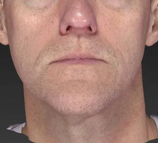 After A slimmer, more taut jawline is shown here after an Ultherapy treatment.