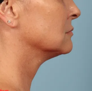 Before This woman met her goals with Dr. Kavali by having a facelift with necklift to tighten her jawline and neck.