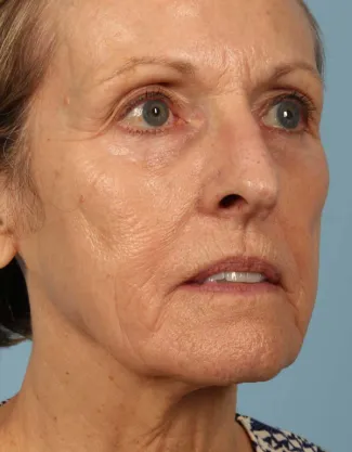 Before This 68 year old Atlanta woman had a consultation with Dr. Kavali for facial rejuvenation.  Together, they decided that a variety of fillers would be best.  She had 4 syringes of Voluma in her cheeks, a syringe of Restylane Silk in her lips and around her mouth for the fine lines, and a syringe of Juvederm Ultra Plus in the nasolabial folds (smile lines). She is shown about 2 weeks after her treatment was done.