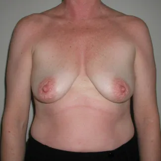 Before This woman desired fuller breasts and needed a lift at the same time. We used 390 cc gel implants beneath the muscle. Her “after” photos were taken about 5 years after her surgery.