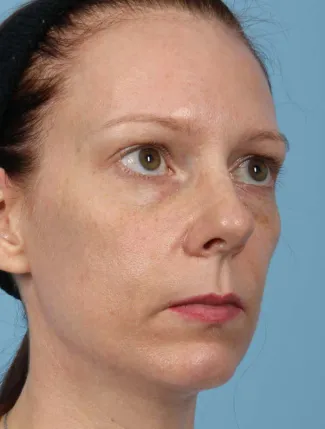 Before This 43 year old Atlanta woman chose fillers for facial rejuvenation.  Dr. Kavali used Voluma in the cheeks and Restylane in the hollows under the eyes.  Her “after” photos were taken immediately following the treatment.