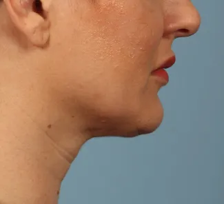 After Results after a single treatment with Kybella