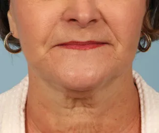 Before This woman is shown about 6 months after her facelift and necklift with Dr. Kavali.