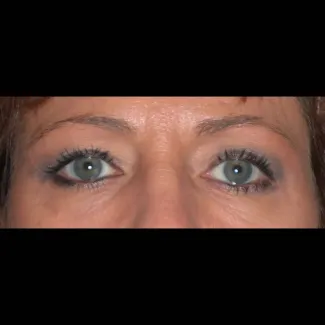 Before This 50 year old female wanted a more “open” look to her eyes.  She had an upper blepharoplasty to remove excess skin and fat from her upper eyelids.  Her “after” photos were taken about 1 year after surgery.