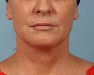 Before A smoother, tighter jawline, neck and lower face after a facelift and necklift.  The after photo is about 1 year after surgery.