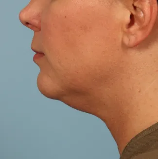 Before Results after 3 Kybella treatments