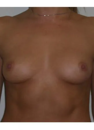 Before This 26 year old female chose 325 cc silicone gel implants, which were placed beneath the muscle.