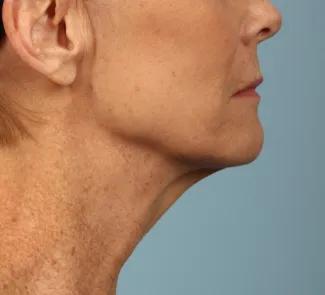Before A smoother, tighter jawline, neck and lower face after a facelift and necklift.  The after photo is about 1 year after surgery.