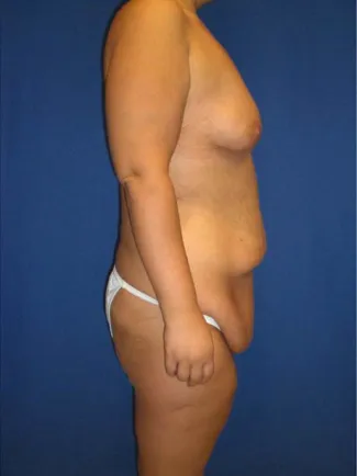 Before This 20 year old female lost 120 pounds after gastric bypass surgery.  Dr. Kavali performed a Lower Body Lift, Upper Body Lift, Vertical Thigh Lift, and Breast Augmentation and Lift using 400 cc gel implants.