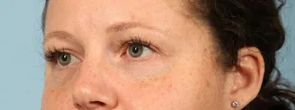 Before After 1 syringe of Juvederm Vollure and 1 syringe of Juvederm Ultra to correct undereye hollows