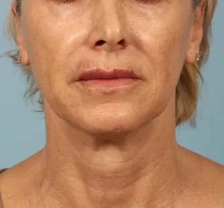 Before A tighter, lifted neck and jawline after Ultherapy at Kavali Plastic Surgery