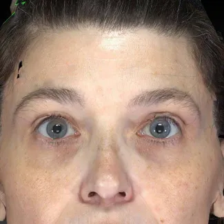 After The power of Ulthera to lift the brows is shown here.