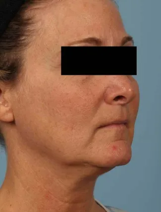 Before This 52 year-old Atlanta woman wanted a more youthful contour to her face, as well as smoother lines and brighter skin.  She has eMatrix sublative skin treatments, and she had 3 syringes of Voluma in her cheeks, and one syringe of Juvederm Ultra Plus in her nasolabial folds (smile lines).