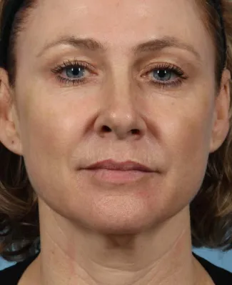 After This 50 year-old Atlanta woman chose Voluma to restore the youthful curves in her cheeks.  Her “after” photos are taken about 1 week after the treatment was done.  The goal is to give a subtle “lift” to the cheeks, which also improves the under-eye area.