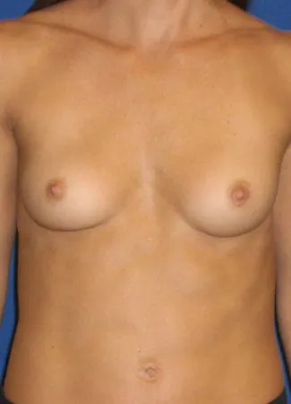 Before This 30 year old female desired breast augmentation, but didn’t want to be too large for her frame.  She also had some mild asymmetry, so she had a 240 cc implant for larger side and a 304 cc implant for the smaller.  Her 