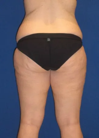 Before This woman had an abdominoplasty (tummy  tuck) at the same time as liposuction of her hips, waist, and inner and outer thighs.