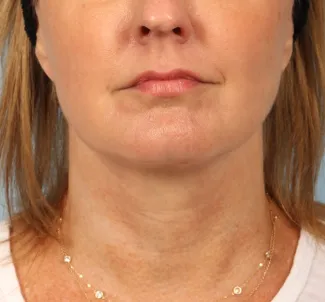 After A facelift and a TCA peel were used in combination to give this Atlanta woman a brighter, tighter look.