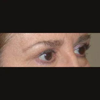 After This 61 year old female had upper eyelid contouring (blepharoplasty) to remove extra fat and skin from her upper eyelids.