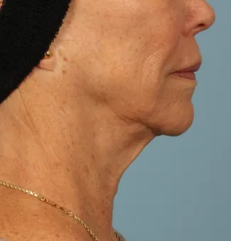 After Ulthera results: note the slimmer neck and tighter jawline.