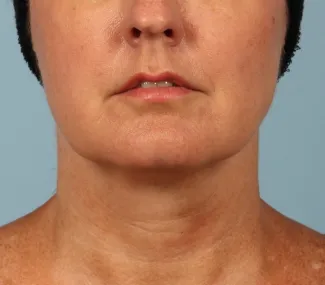 Before A facelift and a TCA peel were used in combination to give this Atlanta woman a brighter, tighter look.