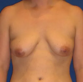 Before This woman in her mid-30s desired breast augmentation (implants) and a lift. She had some breast asymmetry, so a 371 cc gel implant was used on the left and a 339 cc gel implant was used on the right. Her “after” photos were taken about 4 years after her surgery.