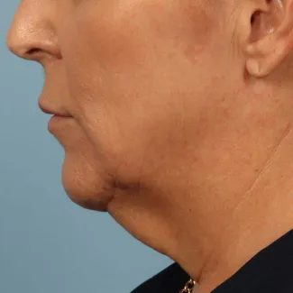 Before This 58 year old Atlanta woman chose Kybella with Dr. Kavali to reduce the fullness in her neck.  Her results are shown 6 months after 3 Kybella treatments. She is thrilled with her results!