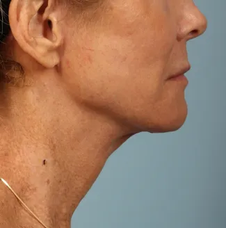 After A smoother, tighter jawline, neck and lower face after a facelift and necklift.  The after photo is about 1 year after surgery.