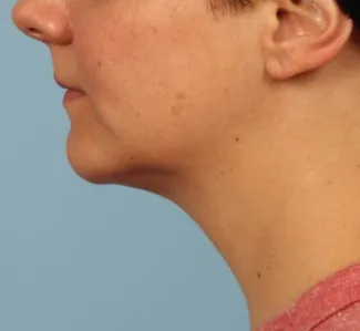 After Results after two Kybella treatments