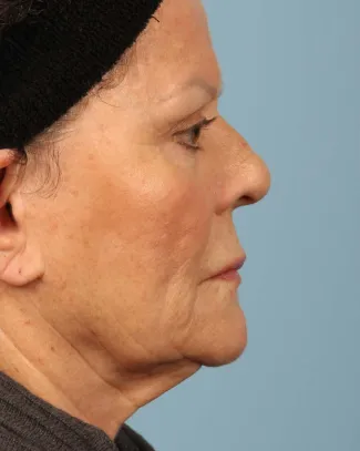 Before This 71 year-old female didn’t want any surgery, but wanted a fresher look.  She had 3 syringes of Voluma, as well as Botox for her “11s”, forehead, and crows’ feet.  She is shown about 3 months after her treatment was done.