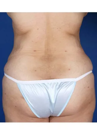 After This 30 year old female desired more buttock shape, as well as a smaller waist.  Dr. Kavali accomplished these two things by removing fat from her abdomen and waist, then transferring it (fat grafting) to both buttocks and hips.  Note that the remaining loose skin in her abdomen will be addressed by an abdominoplasty (tummy tuck) in the future, as part of this woman’s overall surgical plan.