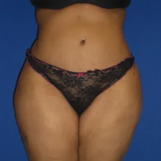After This Georgia mom had an abdominoplasty (tummy tuck)  to remove loose skin and tighten her tummy muscles. She also had liposuction of her waist at the same time.  She is shown about 6 years after surgery.