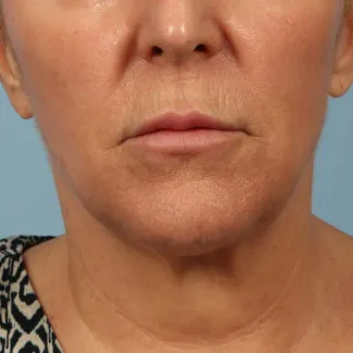 After This 58 year old Atlanta woman chose Kybella with Dr. Kavali to reduce the fullness in her neck.  Her results are shown 6 months after 3 Kybella treatments. She is thrilled with her results!