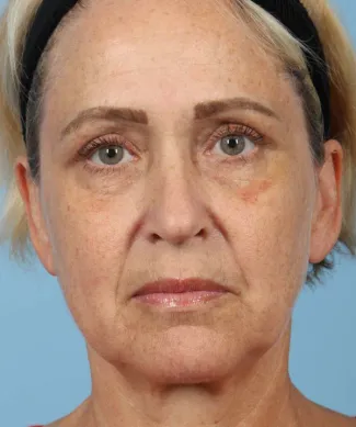 Before This 56 year-old Atlanta woman had a consultation with Dr. Kavali and decided to have Voluma for facial volume replacement.  She is shown after having 4 syringes of Voluma.