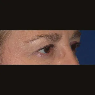 Before This 61 year old female had upper eyelid contouring (blepharoplasty) to remove extra fat and skin from her upper eyelids.