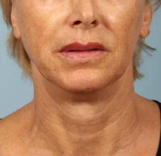 After A tighter, lifted neck and jawline after Ultherapy at Kavali Plastic Surgery