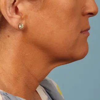 After Results after 2 Kybella treatments