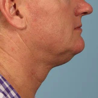 Before Results after 2 Kybella Treatments