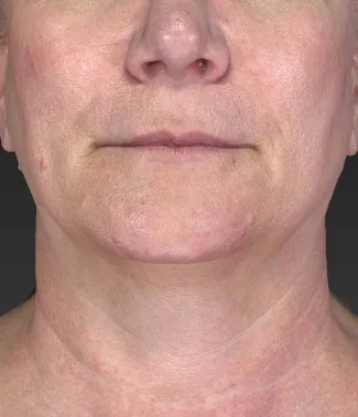 After Ulthera gave this woman an amazing result!  No other treatments were done.  Ulthera alone is responsible for this tighter, slimmer neck and jawline!