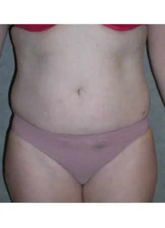 Before This Atlanta mom had an abdominoplasty (tummy tuck) to remove loose skin and tighten her tummy muscles. She also had liposuction of her waist at the same time.  She is shown about 1 year after surgery.