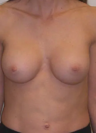 After This 30 year old female desired breast augmentation, but didn’t want to be too large for her frame.  She also had some mild asymmetry, so she had a 240 cc implant for larger side and a 304 cc implant for the smaller.  Her 