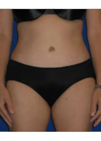After This Atlanta mom had an abdominoplasty (tummy tuck)  to remove loose skin and tighten her tummy muscles. She also had liposuction of her waist at the same time.  She is shown about 1 year after surgery.